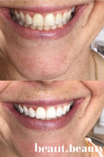 Peachy Kleen Smile Kit